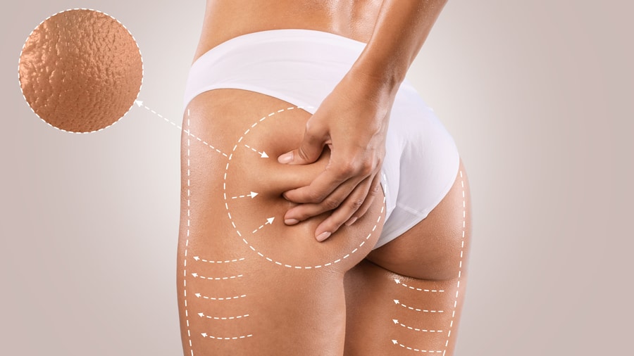 A white woman with cellulite on her buttocks.