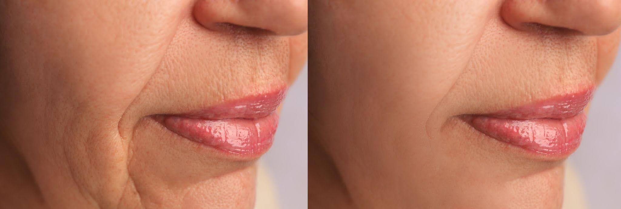 Before and after images showing a woman lips highlighting a noticeable enhancement in fullness and shape